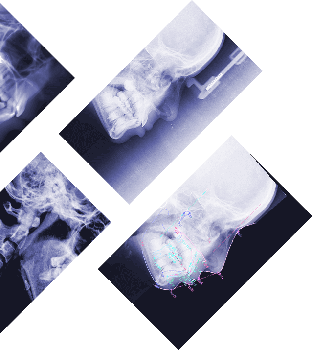 Analyse céphalometrique